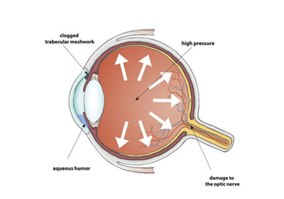 Glaucoma