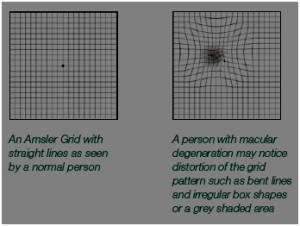 Fig 3. Amsler Grid test