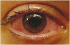 Anterior Uveitis