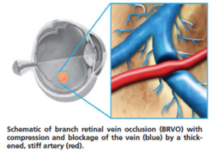 branch-retinal-vein-occlusion