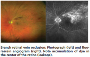 branch-retinal-vein-occlusion2