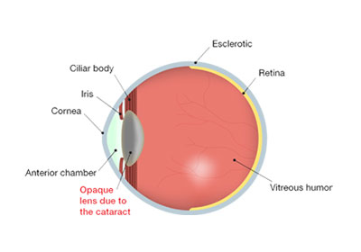 cataract