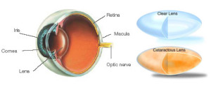 Cataractous Lens vs Clear Lens