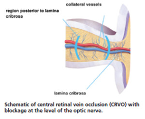 central-retinal-vein-occlusion