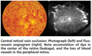 central-retinal-vein-occlusion1