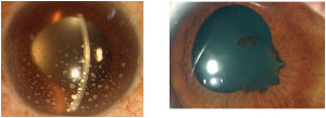 Changes in uveitis