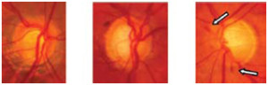 Photos of cupped discs: in the third disc small disc haemorrhages also typical of glaucoma can be seen