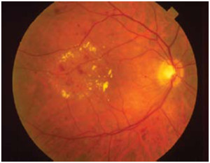 Small bleeds and areas of blood vessel leakage in an eye with macular oedema. Yellow deposits are lipid.