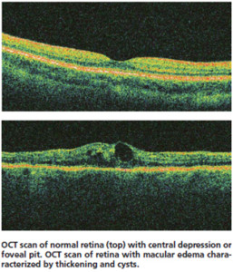 oct-scan-of-normal-retina