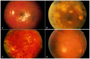 Posterior Uveitis