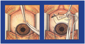 Squint surgery