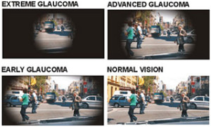 Pattern of vision loss in glaucoma 